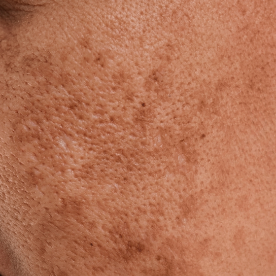 Pigmentation