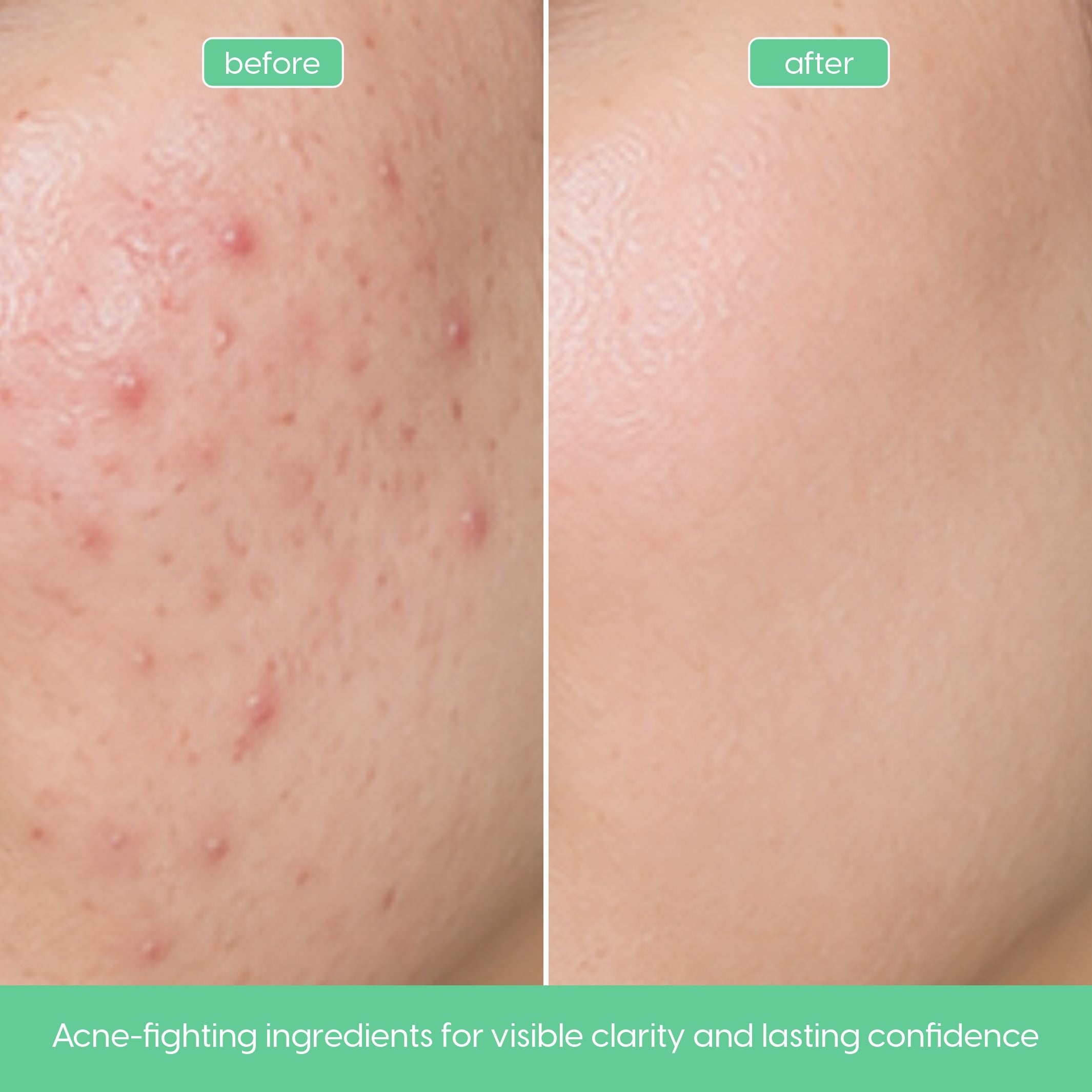 Advanced Anti-Acne Serum with Salicylic Acid for Breakout-Prone Skin