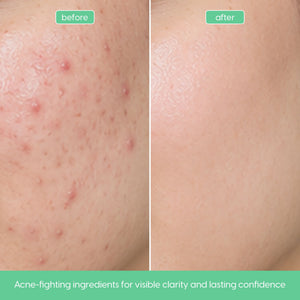 Advanced Anti-Acne Serum with Salicylic Acid for Breakout-Prone Skin