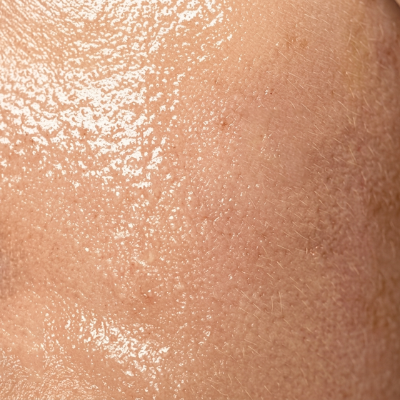 Oily Skin