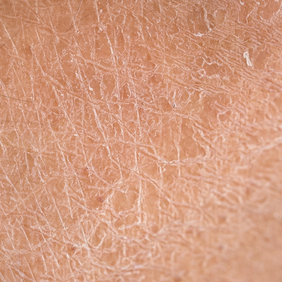 Dry Skin