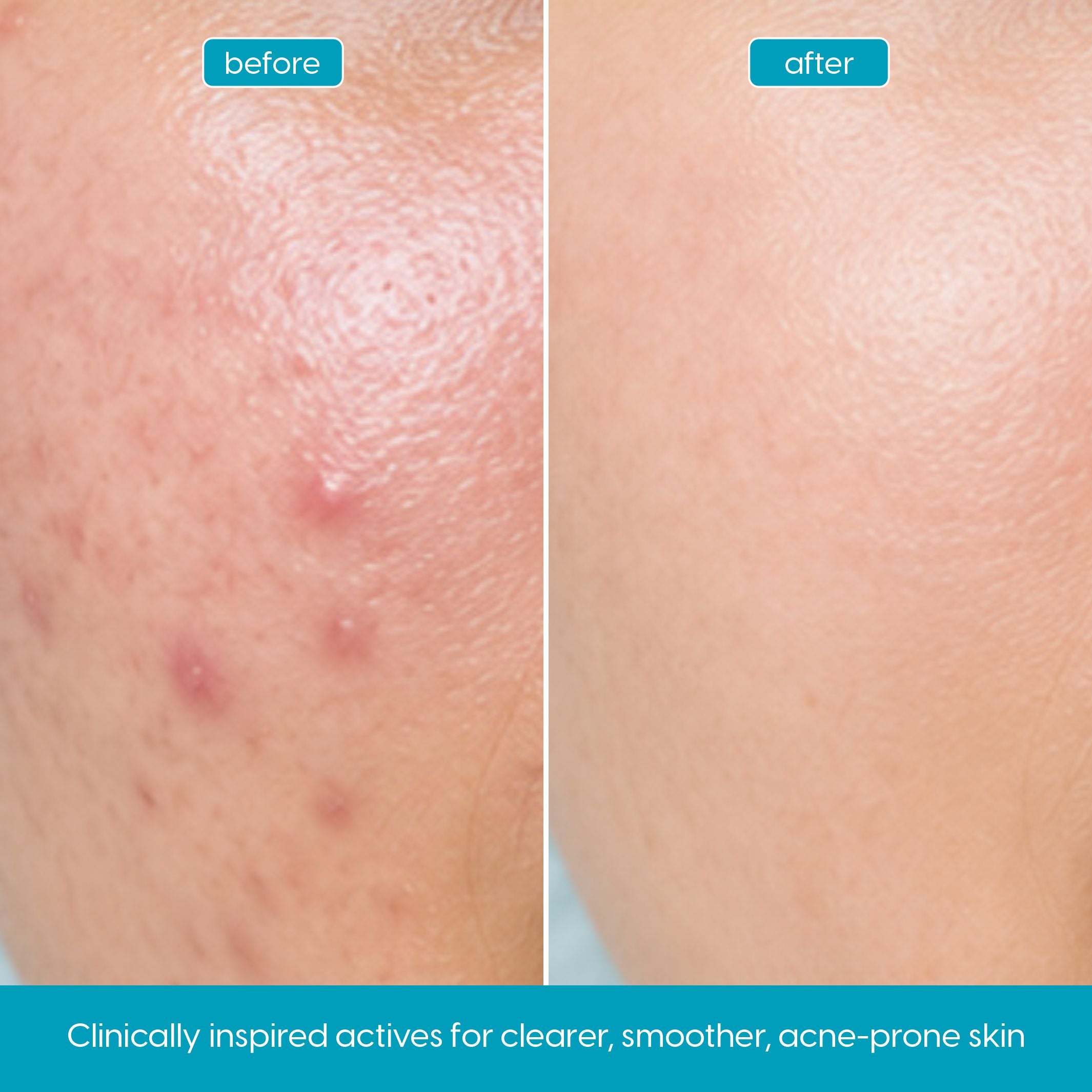 Anti-Acne Salicylic Acid 2% Serum for Oily, Breakout-Prone Skin